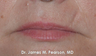 Lip Reconstruction