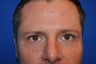 44 Year Old Male Lower Blepharoplasty to Eliminate Puffy Under-Eye Bags