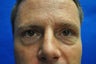 44 Year Old Male Lower Blepharoplasty to Eliminate Puffy Under-Eye Bags