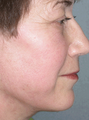 Facelift