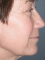 Facelift