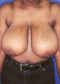 Female Breast Reduction