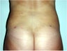 Liposuction
