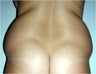 Liposuction