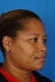 43 year old female treated for fullness under the chin and jawline.