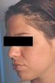 Photodynamic Therapy