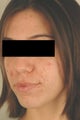 Photodynamic Therapy