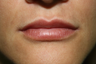 Facial Filler 