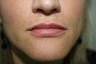 Facial Filler 