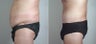 25 year old male with large weight loss had tummy tuck