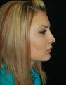 Rhinoplasty