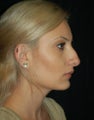 Rhinoplasty
