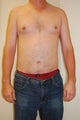 37 year old male liposuction upper and lower abdomen and flanks