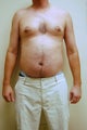 37 year old male liposuction upper and lower abdomen and flanks