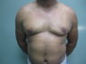 28 Year Old Male, had Subcutaneous Mastectomy