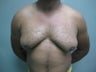 28 Year Old Male, had Subcutaneous Mastectomy