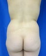 Brazilian Butt Lift