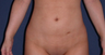 liposuction