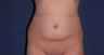 liposuction