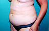 46 year old female patient 