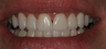 Porcelain Veneers