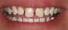 Porcelain Veneers