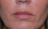 Filler