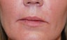 Filler