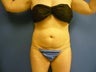 Lipsuction of Abdomen and Waist