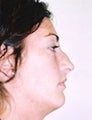 Female patient who underwent nose surgery with a chin implant 