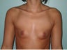 28 year old female patient who underwent a breast augmentation with implants 