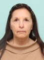 Laser Resurfacing