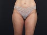 Liposuction Inner & Outer Thighs