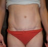 Tummy Tuck