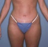 Male Liposuction
