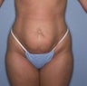 Male Liposuction