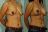 Breast Lift