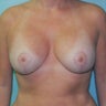 Breast Lift