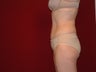 Liposuction