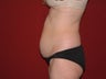 Liposuction