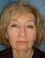 Eyelid Surgery