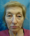 Eyelid Surgery