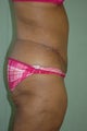 Body lift