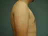 16 Year Old Male Treated For Gynecomastectomy