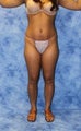 Brazilian Butt Lift and creating curves