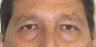Asian eyelid surgery 