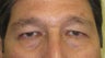 Asian eyelid surgery 