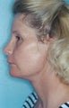 Facelift