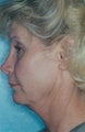 Facelift