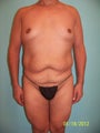 45 Year Old Male - Tummy Tuck